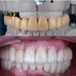 dental implant