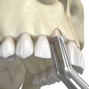 bone graft