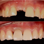 case implant