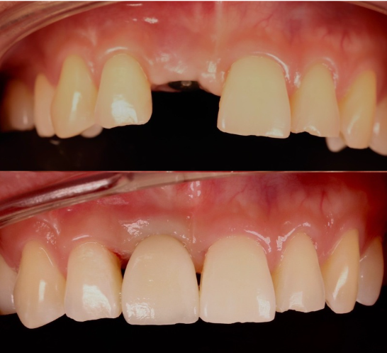 case implant