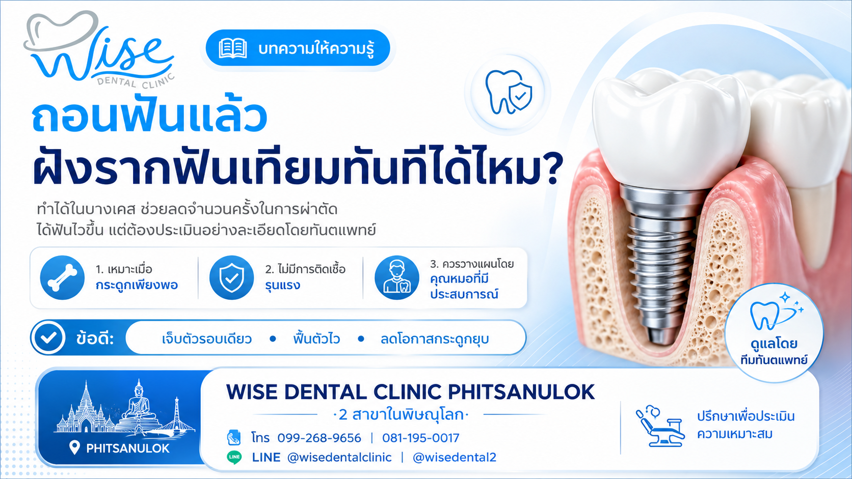 ถอนฟันแล้วฝังรากฟันเทียมทันที